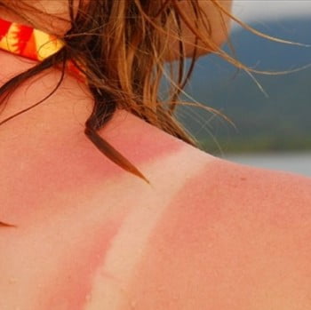 arsura solara 2- 350×350 femeie cu arsura solară pe spate