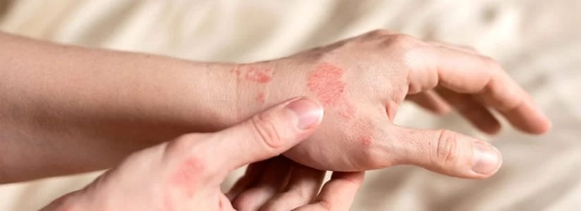dermatita-atopică