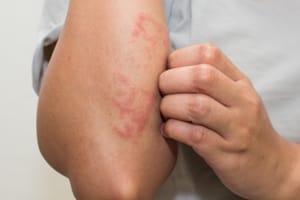 eczemă-pe-mână eczema-pe-mana