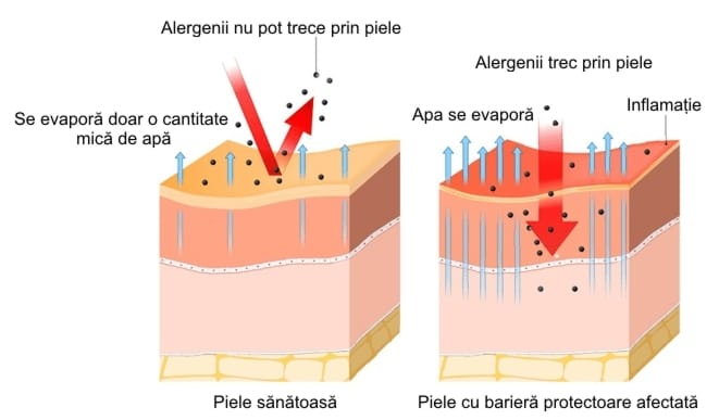 piele sănătoasă vs eczemă simptome-dermatita-alergică