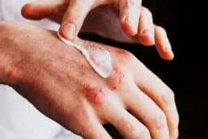 tratament-eczema tratament-eczemă